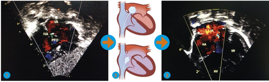 Prosedyren ved ballongatrieseptostomi: Bilde 1 viser restriktivt atrieseptum med lite blodstrøm over foramen ovale (PFO). Bilde 2 viser (øverst) kateter med Rashkind-ballong som er ført inn i høyre atrium via foramen ovale, og deretter (nederst) etter at oppblåst ballong er trukket gjennom atrieseptum for å utvide hullet. Bilde 3 viser resultat med stor defekt i atrieseptum og god miksing av blod på atrie-nivå.