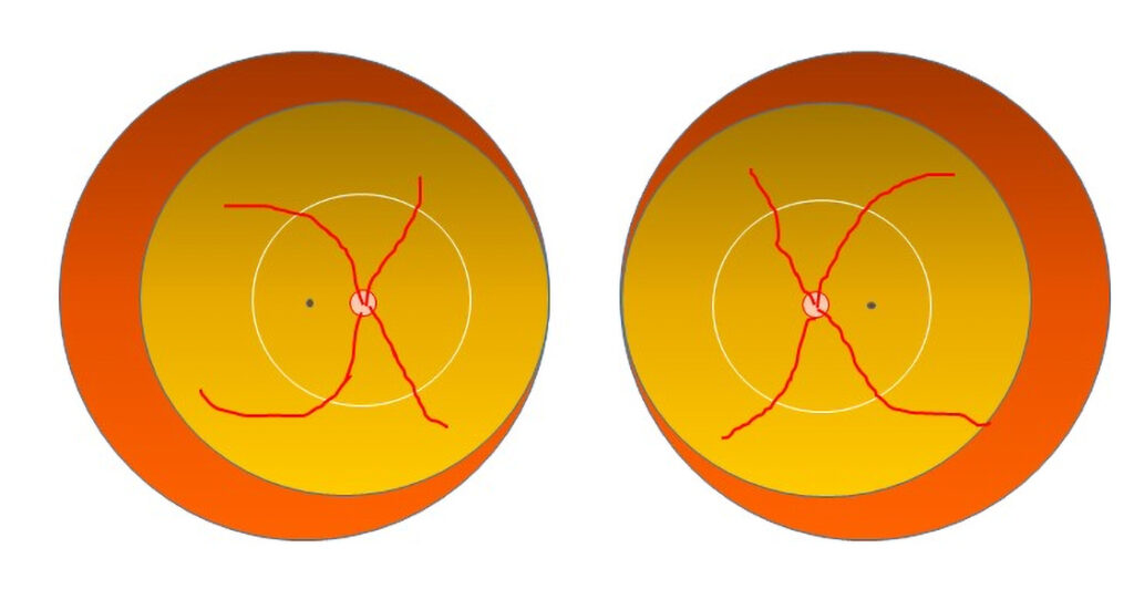 Figur 1. Sone 1 tilsvarer området omkring papillen, innenfor den lyse sirkelen (radius = 2x avstand papille-fovea centralis). Sone 2 er resten av den gule sirkelen (utenfor sone 1), mens sone 3 er det gjenværende sigdformede oransje området.