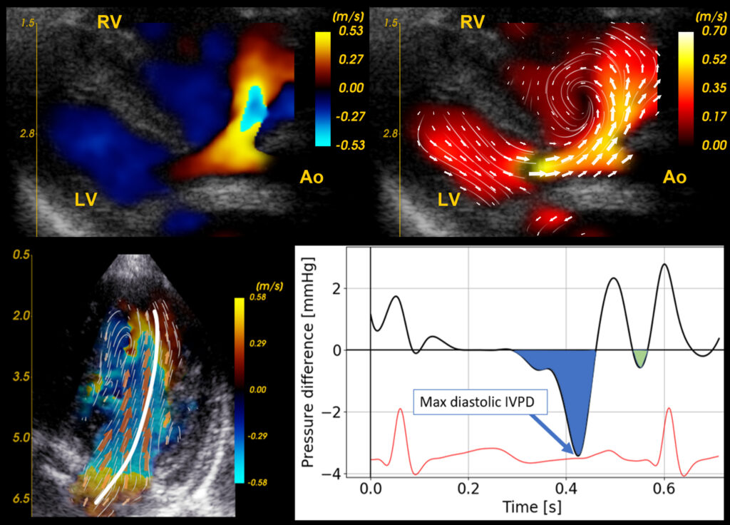 Figur 1: Blood Speckle ­Tracking (BST)Øvre panel: Ultralydbilde av hjertet til nyfødt. LV = venstre hjertekammer. RV = høyre hjertekammer. Ao= Aorta (hovedpulsåre). Bildet viser farge-Doppler avbildning til venstre, BST til høyre hvor man ser at blodet passerer gjennom en åpning mellom hjerte­kamrene og lager en virvel i høyre hjertekammer. Nedre panel: Intraventrikulær trykkforskjell langs den avbildede strømningsbanen fra mitralklaff til apex, vist til ­venstre (frisk kontroll). Maksimal intraventrikulær trykkforskjell (IVPD) i tidlig diastole er merket med den blå pilen til høyre. Verdiene hentes ut av analyse­programmet vi bruker.