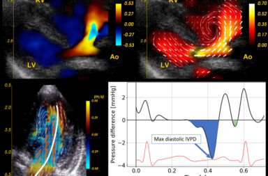 Figur 1: Blood Speckle ­Tracking (BST) Øvre panel: Ultralydbilde av hjertet til nyfødt. LV = venstre hjertekammer. RV = høyre hjertekammer. Ao= Aorta (hovedpulsåre). Bildet viser farge-Doppler avbildning til venstre, BST til høyre hvor man ser at blodet passerer gjennom en åpning mellom hjerte­kamrene og lager en virvel i høyre hjertekammer. Nedre panel: Intraventrikulær trykkforskjell langs den avbildede strømningsbanen fra mitralklaff til apex, vist til ­venstre (frisk kontroll). Maksimal intraventrikulær trykkforskjell (IVPD) i tidlig diastole er merket med den blå pilen til høyre. Verdiene hentes ut av analyse­programmet vi bruker.